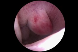 hiperplazie endoemtru