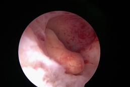 Polip endometrial