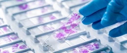 testul hpv la centrul MEDIS